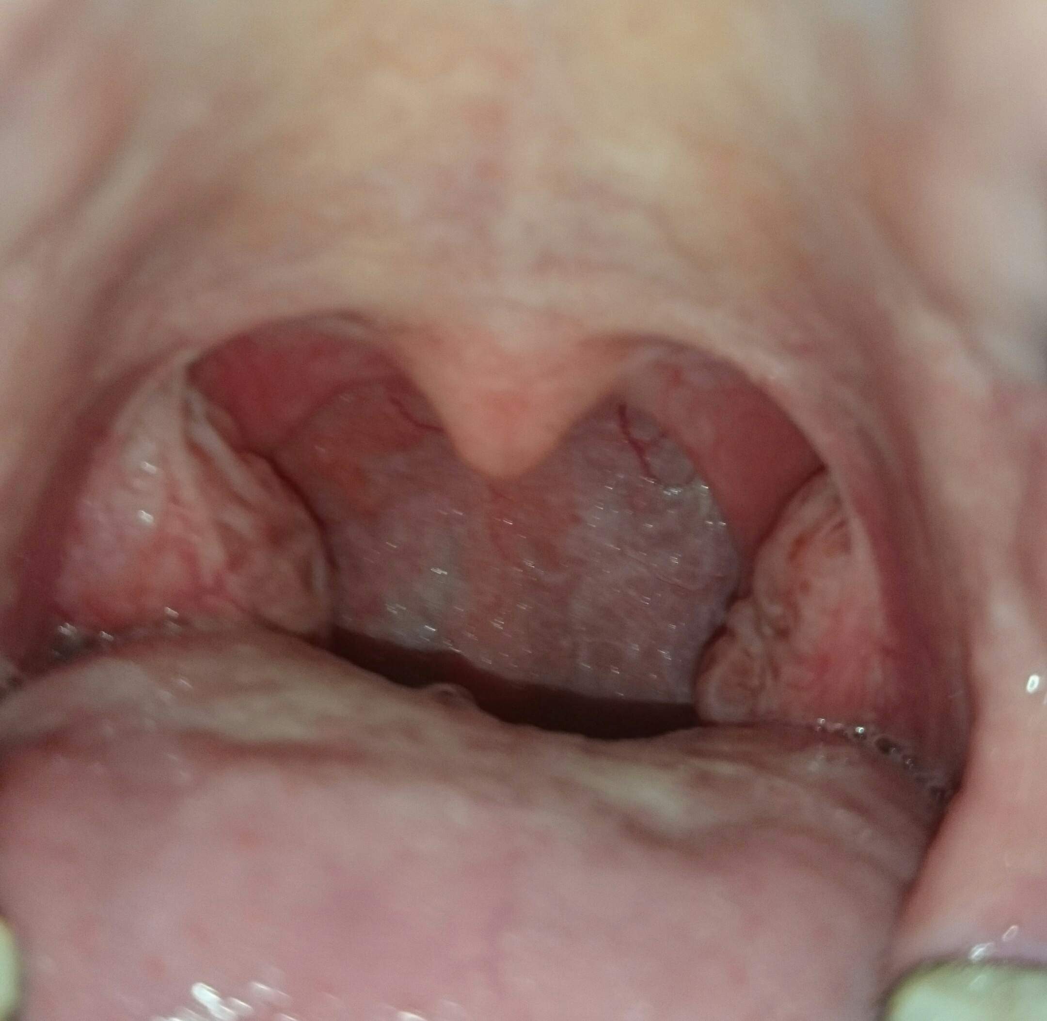 Rachen oder Mandelentzündung? (Entzündung, weiß, Mandeln)