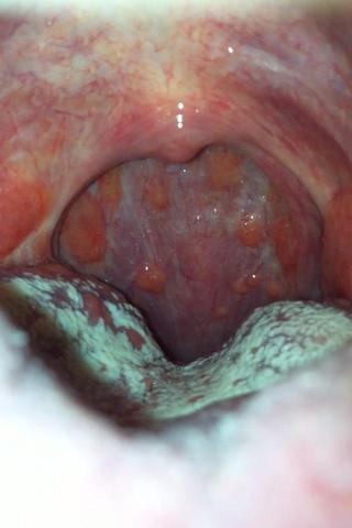 Rachen Rote Punkte Entzundete Lymphknotchen Gesundheit Hals Halsschmerzen Rachen Rote Punkte Entzundete Lymphknotchen Gesundheit Hals Halsschmerzen