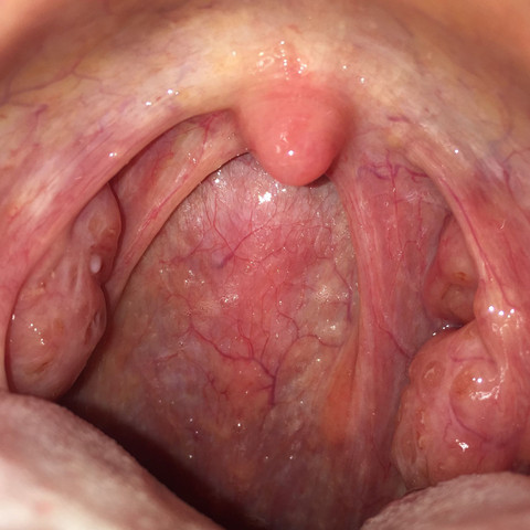 Rachen Seit 3 Monaten Dauerhaft Entzundet Arzte Fraglos Brauche Wirklich Dringend Hilfe Gesundheit Und Medizin Hals Halsschmerzen Rachen Seit 3 Monaten Dauerhaft Entzundet Arzte Fraglos Brauche Wirklich Dringend Hilfe Gesundheit Und Medizin Hals Halsschmerzen