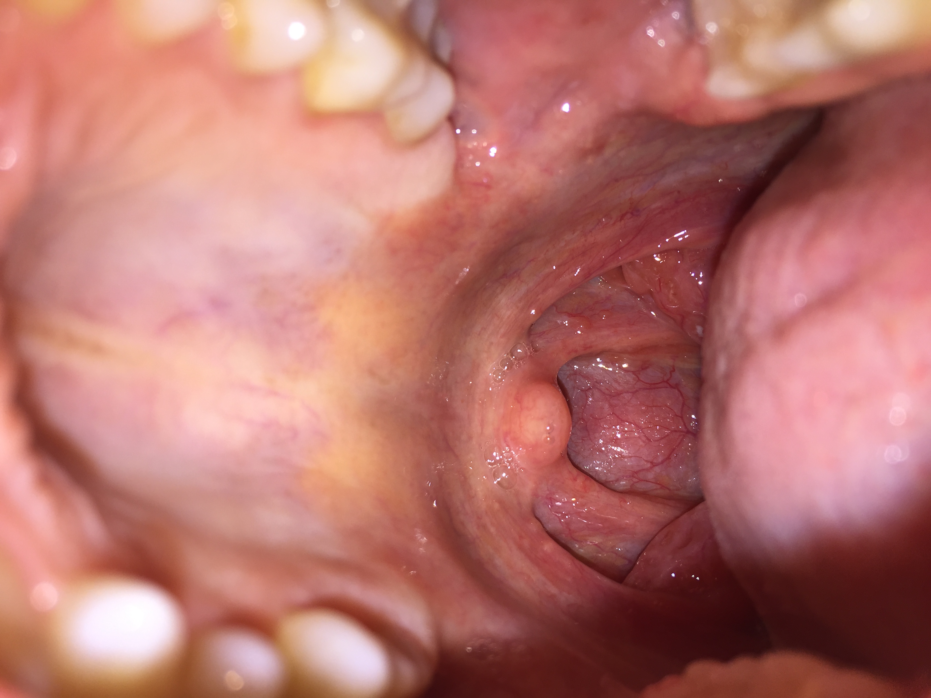 Rachen was ist das? (Medizin)