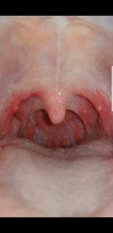 Rachenentzundung Viral Oder Bakteriell Bild Gesundheit Und Medizin Schmerzen Viren Rachenentzundung Viral Oder Bakteriell Bild Gesundheit Und Medizin Schmerzen Viren