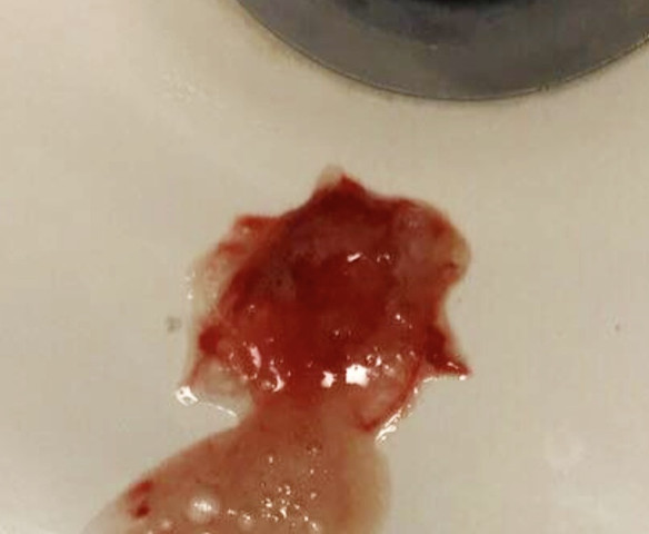 Rauspern Mit Blut Achtung Ecklig Gesundheit Und Medizin Gesundheit Krankheit Rauspern Mit Blut Achtung Ecklig Gesundheit Und Medizin Gesundheit Krankheit