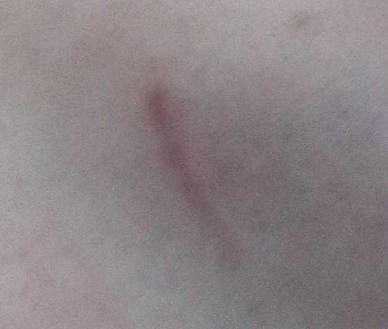 Am rasieren vom narben bein Pickelchen am