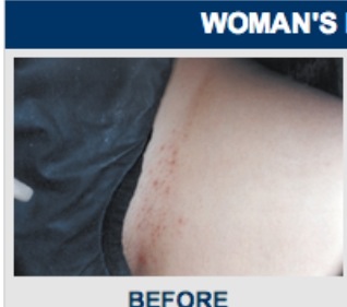 rasierpickel im intimbereich weiblich