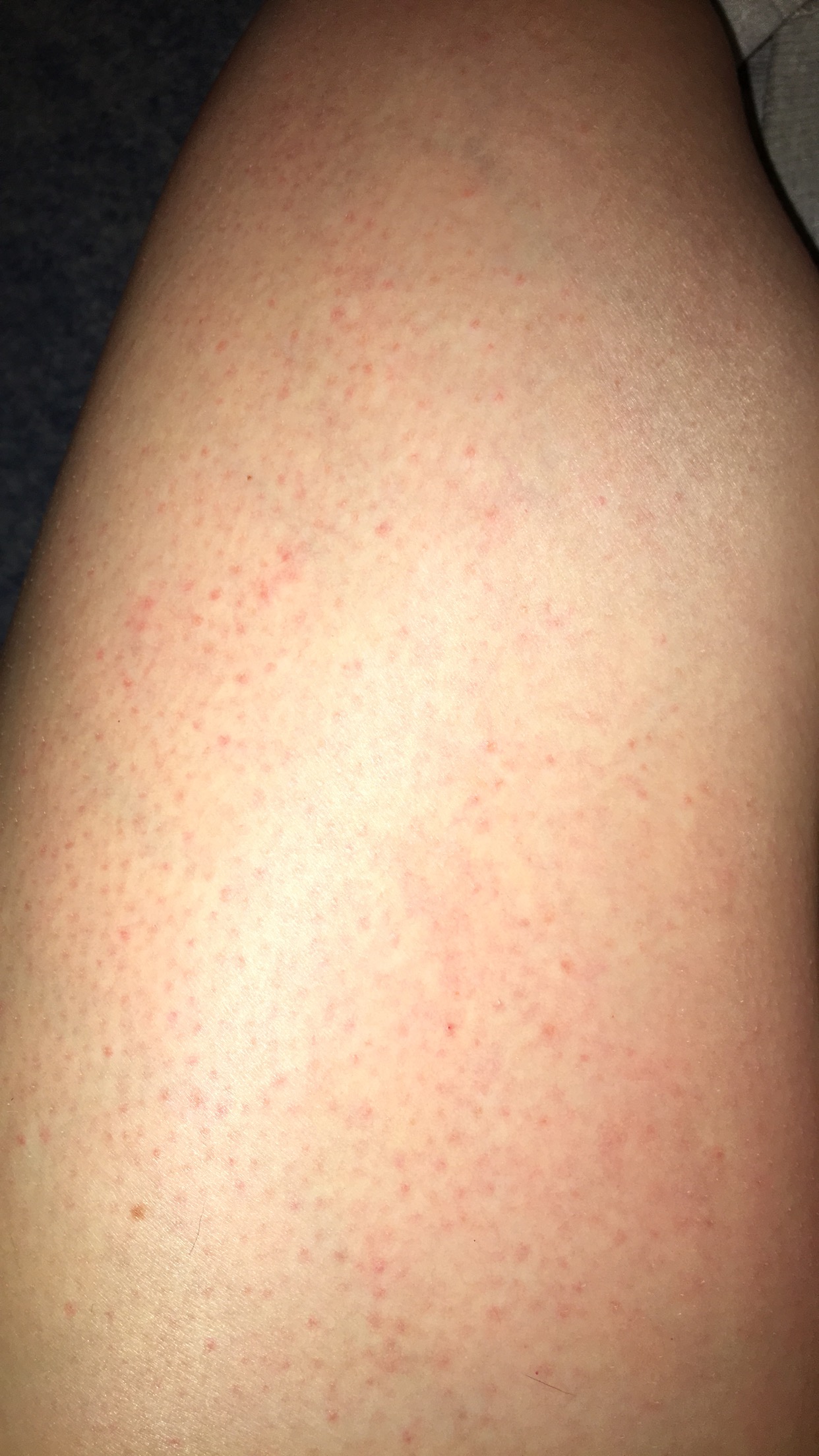 rasierpickel am oberschenkel pickel