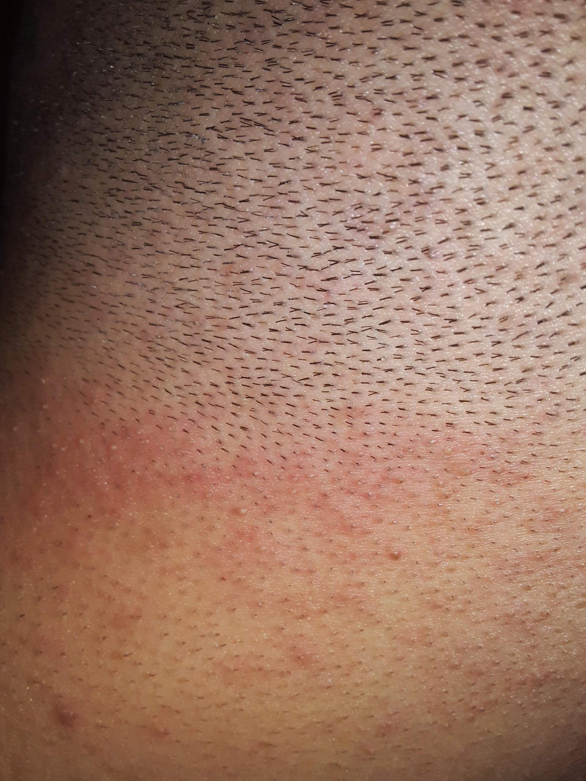 Rasierpickel auf dem kopf? (Pickel, Rasur)