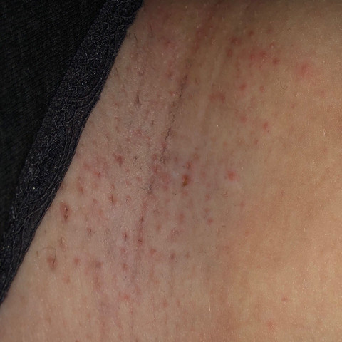Rasierpickel Die Weh Tun Und Brennen Wegbekommen Gesundheit Und Medizin Beauty Pickel Rasierpickel Die Weh Tun Und Brennen Wegbekommen Gesundheit Und Medizin Beauty Pickel