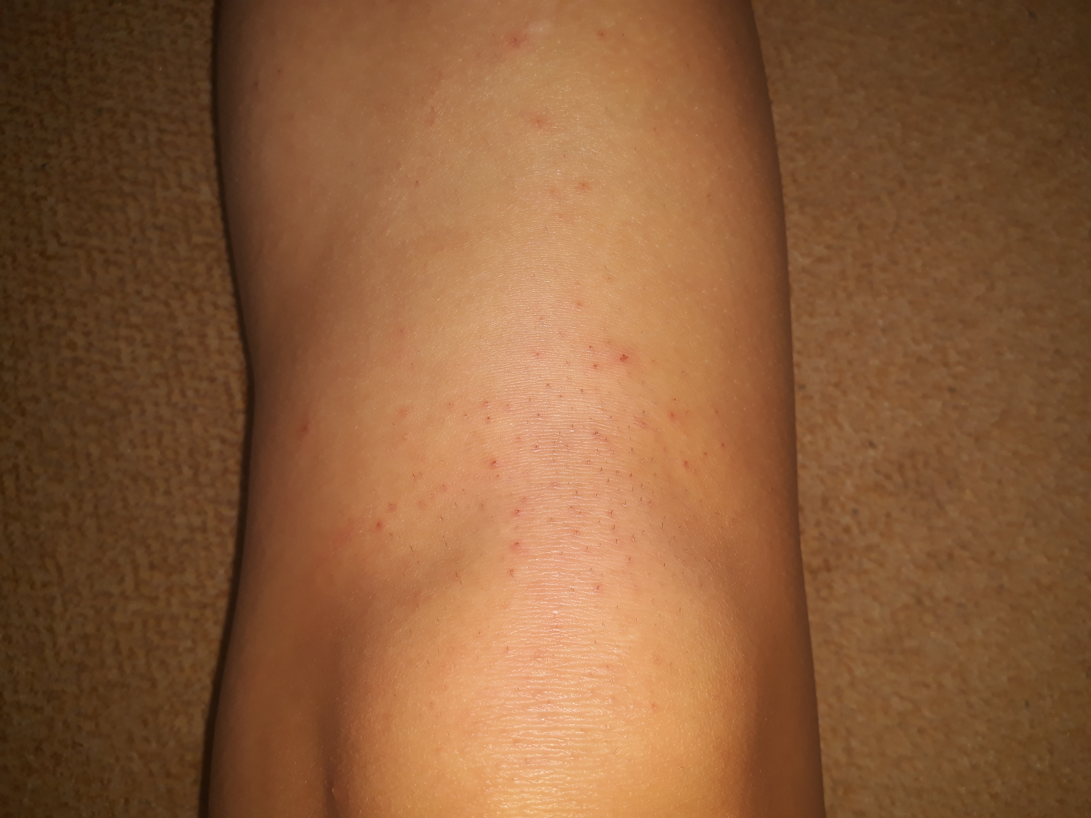 Nach Rasur Juckende Beine Juckreiz Nach Der Rasur 19 12 22