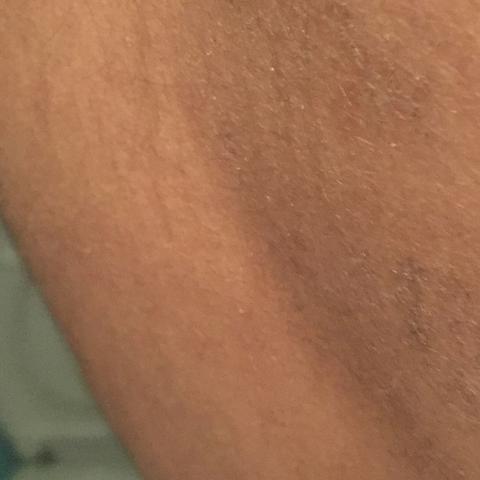 Raue Braune Hautflecken Gesundheit Arzt Haut