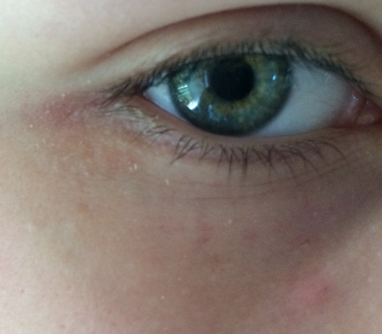 Raue Rotliche Haut Ums Auge Augen Rot Raue Rotliche Haut Ums Auge Augen Rot