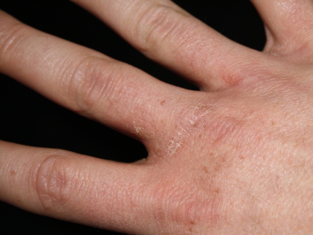 Raue, trockene Hände, was hilft? (Hand, trocken)