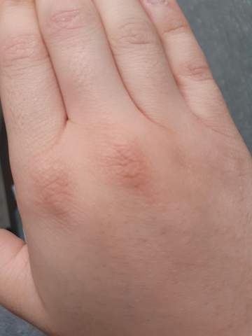 Raue Trockene Haut An Hand Knochel Gesundheit Und Medizin Pflege Hautprobleme