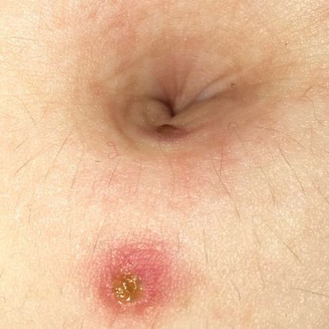 raus gemachtes entzundetes piercing apotheke bauchnabelpiercing entzundet