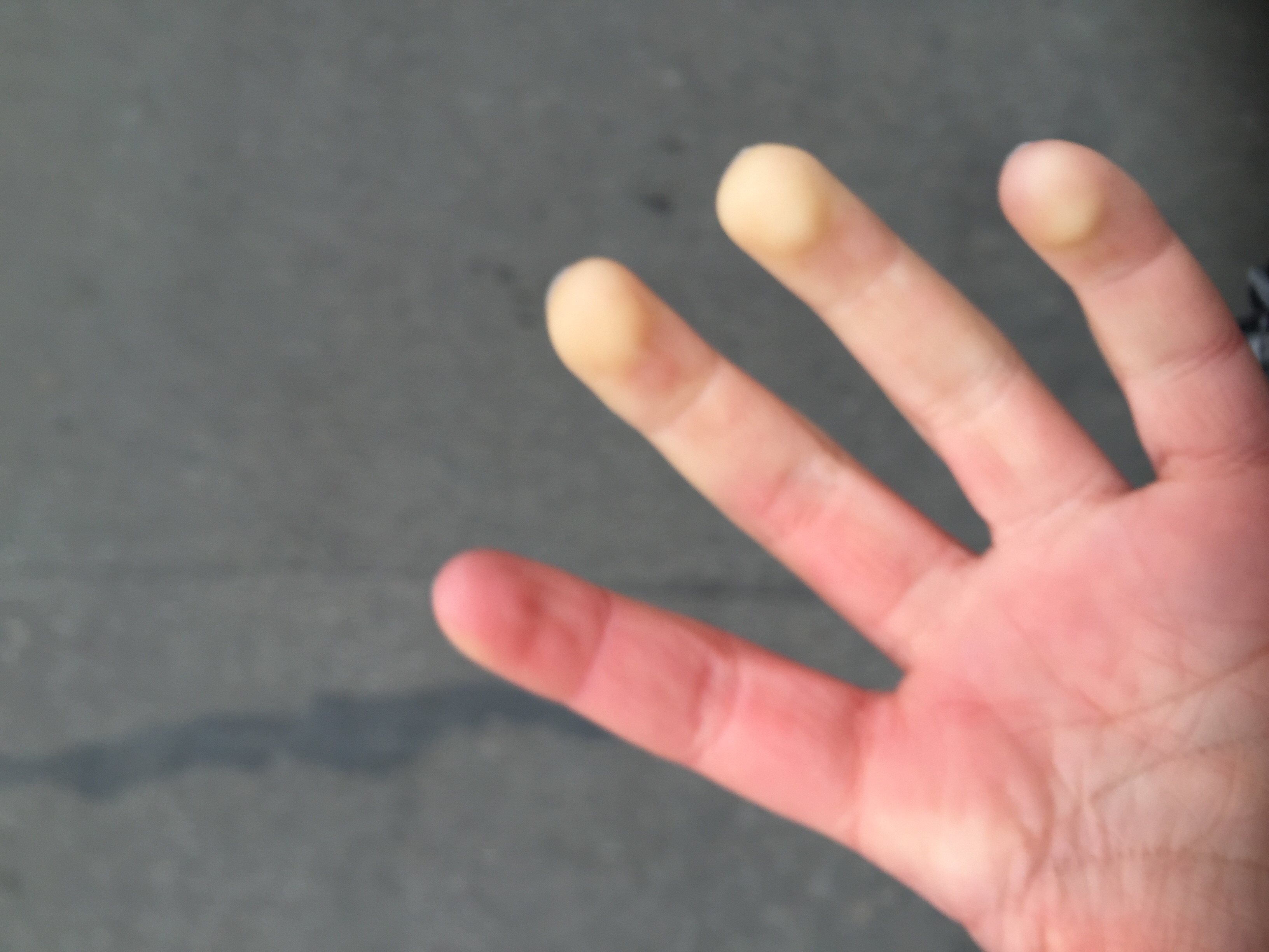 RaynaudSyndrom zum Arzt? (Gesundheit, Medizin, Krankheit)