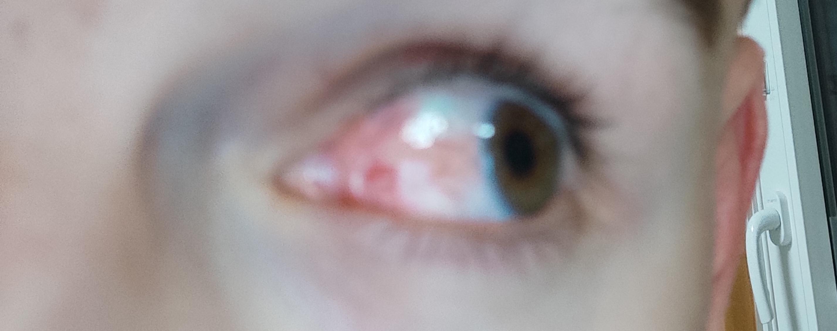 Rechtes Auge oft extrem rot? (Gesundheit und Medizin, Augen)
