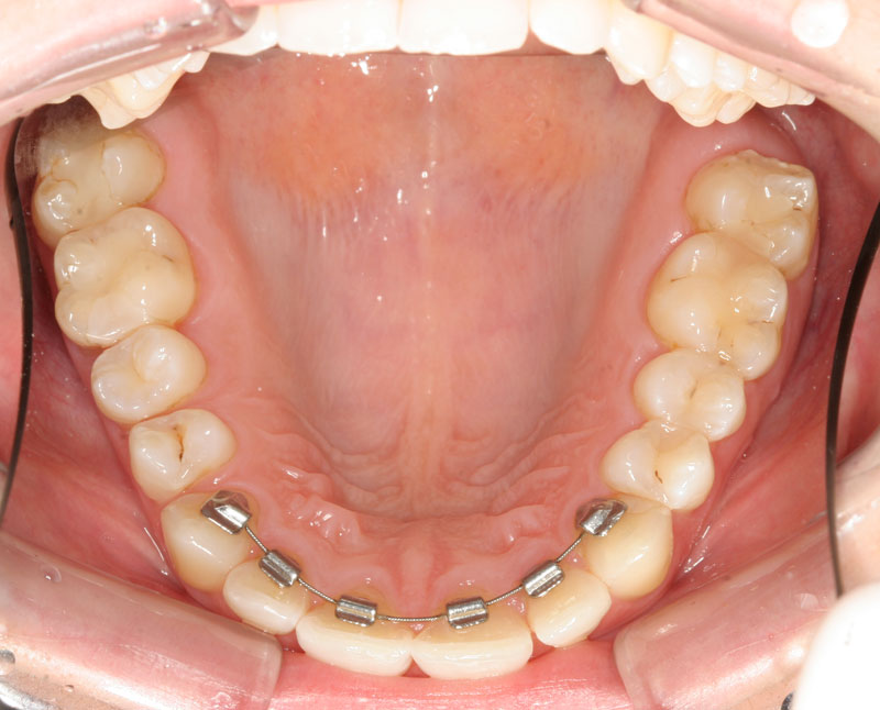 retainer von zahnarzt entfernen lassen (Entfernung)