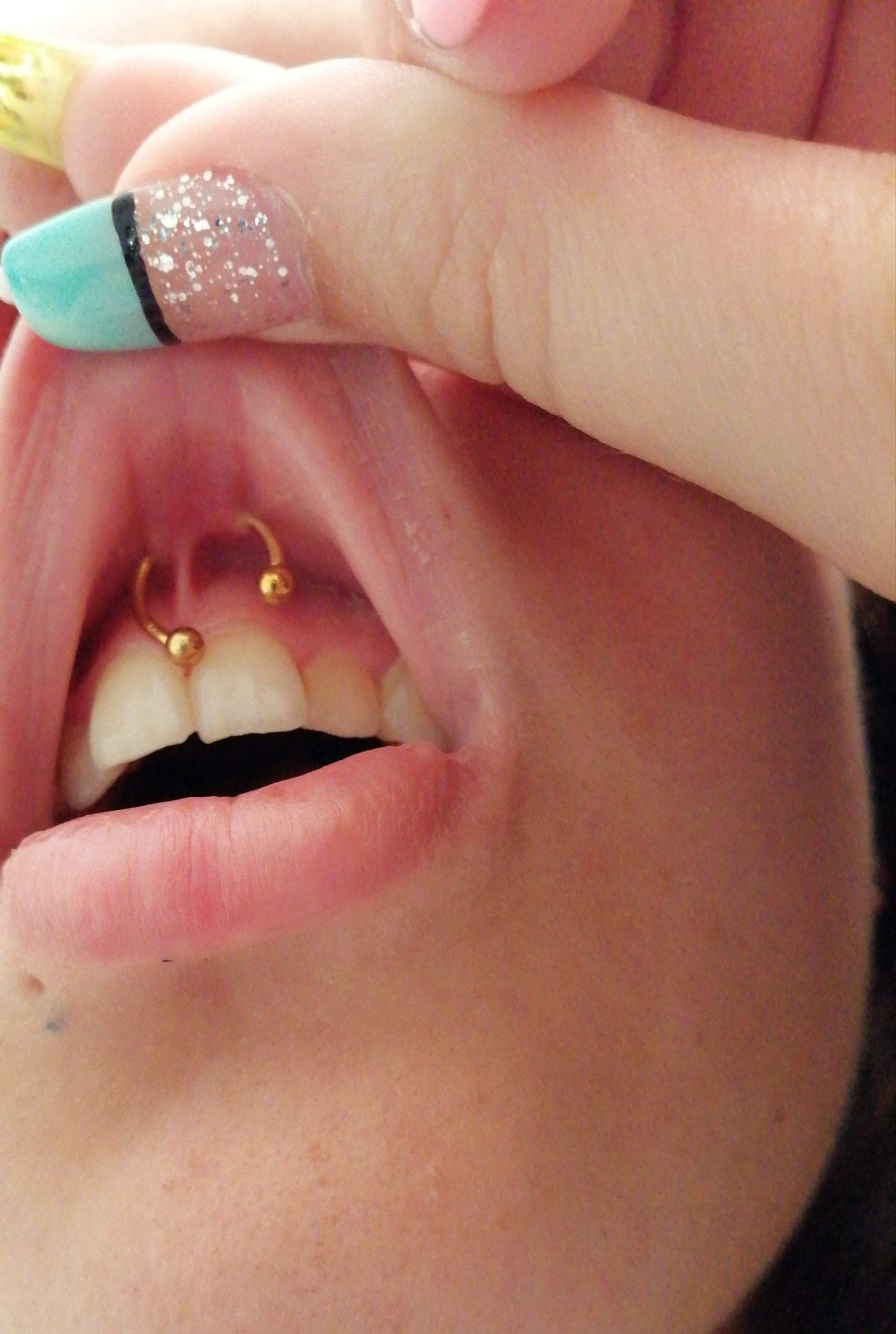 Richtig gestochen (lippenbändchen)? (Piercingstechen) Richtig gestochen (lippenbändchen)? (Piercingstechen)