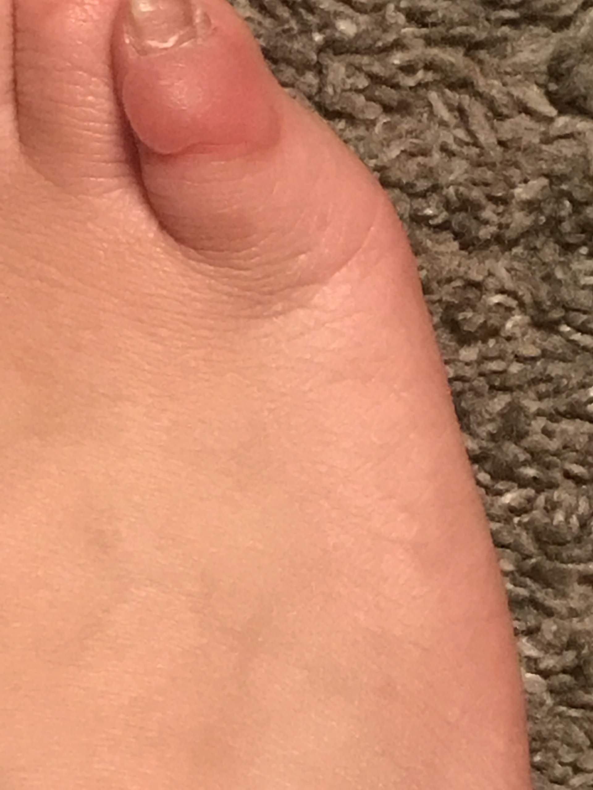 Riese Blase am kleine Zeh hilfe? (Gesundheit und Medizin, Schmerzen) Riese Blase am kleine Zeh hilfe? (Gesundheit und Medizin, Schmerzen)