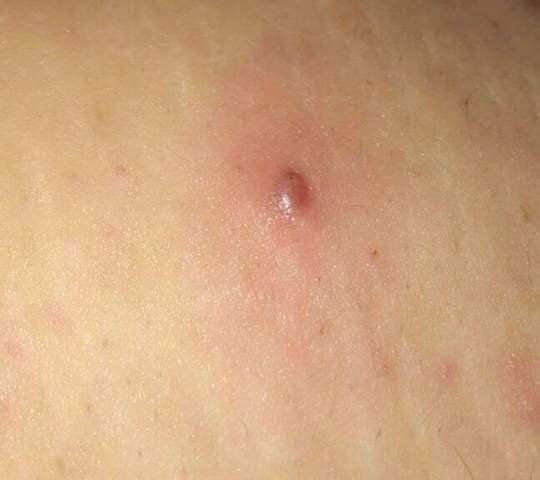 Riesen Pickel Bikinizone Was Tun Mit Bild Gesundheit Und Medizin Gesundheit Furunkel Riesen Pickel Bikinizone Was Tun Mit Bild Gesundheit Und Medizin Gesundheit Furunkel