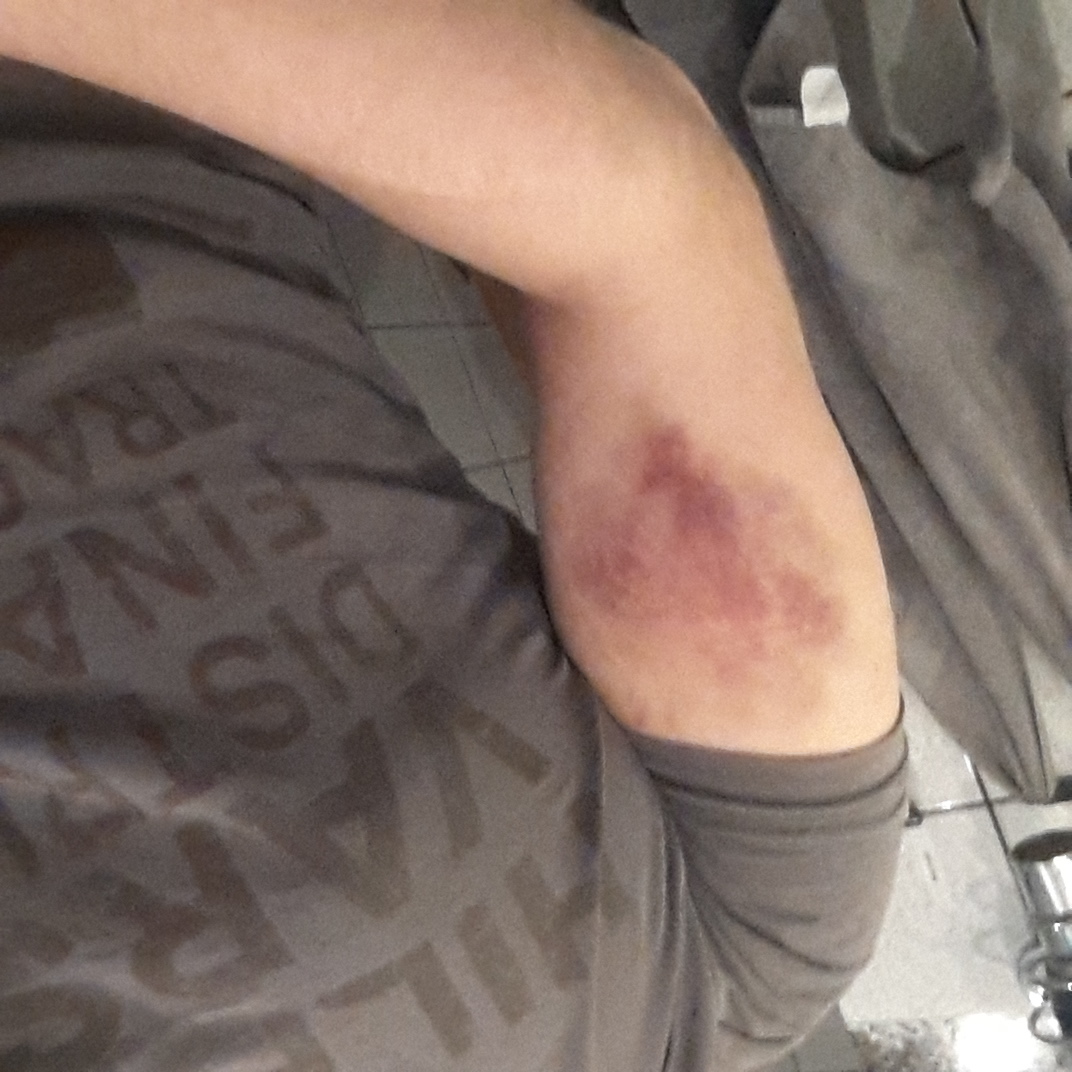 Riesengrosser blauer Fleck (Bild) am Arm wegen Freunden, was kann Riesengrosser blauer Fleck (Bild) am Arm wegen Freunden, was kann