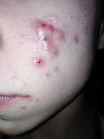 Riesenpickel, unwohl fühlen? (Körper, Pickel, Akne) pickel körper