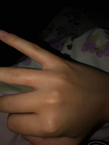 Ringfinger Angeschwollen Warum Gesundheit Und Medizin Schmuck Finger Ringfinger Angeschwollen Warum Gesundheit Und Medizin Schmuck Finger