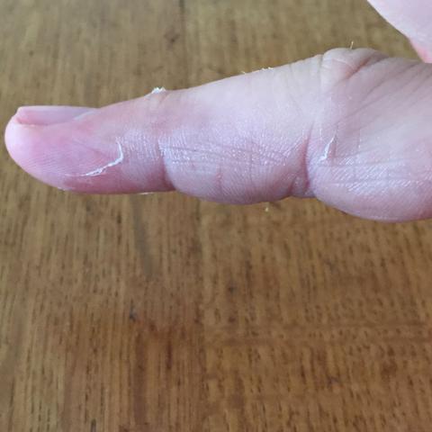 Ringfinger - (Finger, gebrochen)