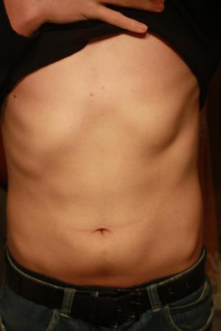 Rippe Gebrochen Oder Nicht Keine Schmerzen Unfall Rippen Rippe Gebrochen Oder Nicht Keine Schmerzen Unfall Rippen