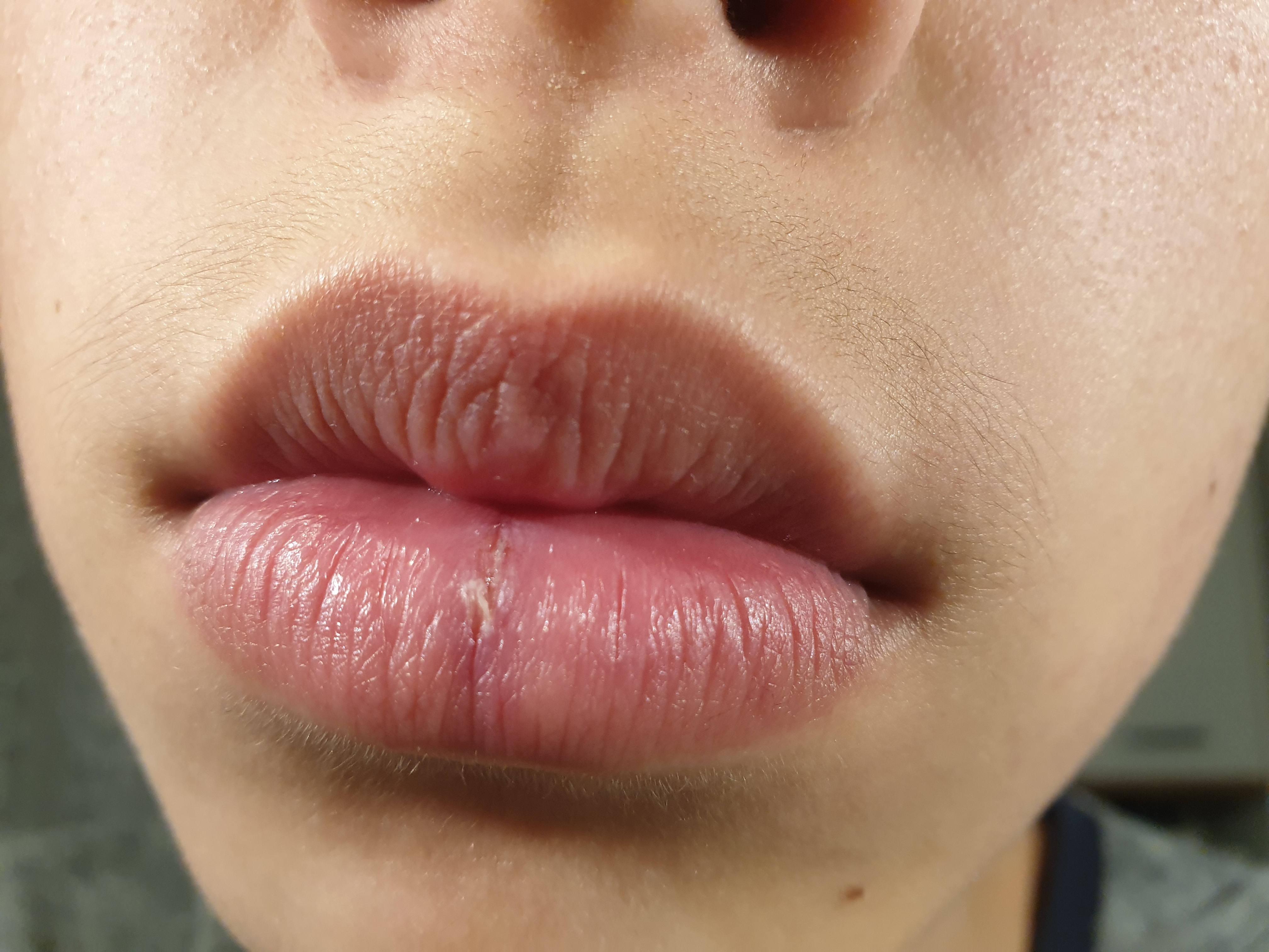 Riss An Der Unteren Lippe Weil Es Vertrocknet Ist Gesundheit Und Medizin Gesundheit Lippenpflege