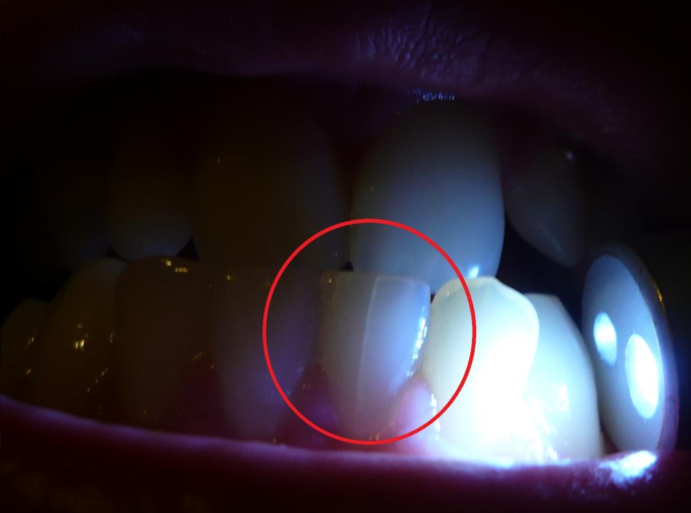 Riss im Zahn (Schmelzriss?) (Zähne, Zahnarzt, Zahnpflege)