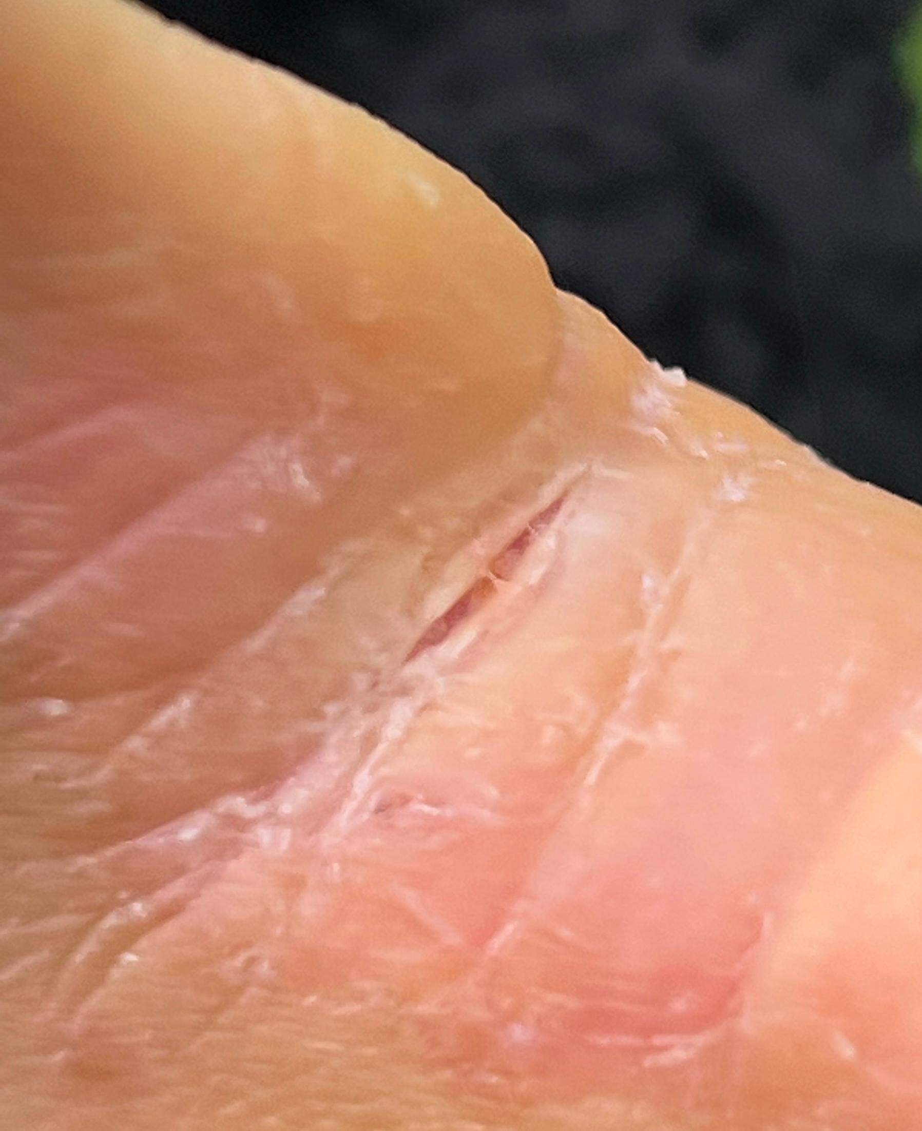 Riss in der Haut, was tun? (Pflege, Hand, Hautarzt)
