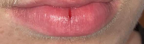 Lippe eingerissene Lippe in