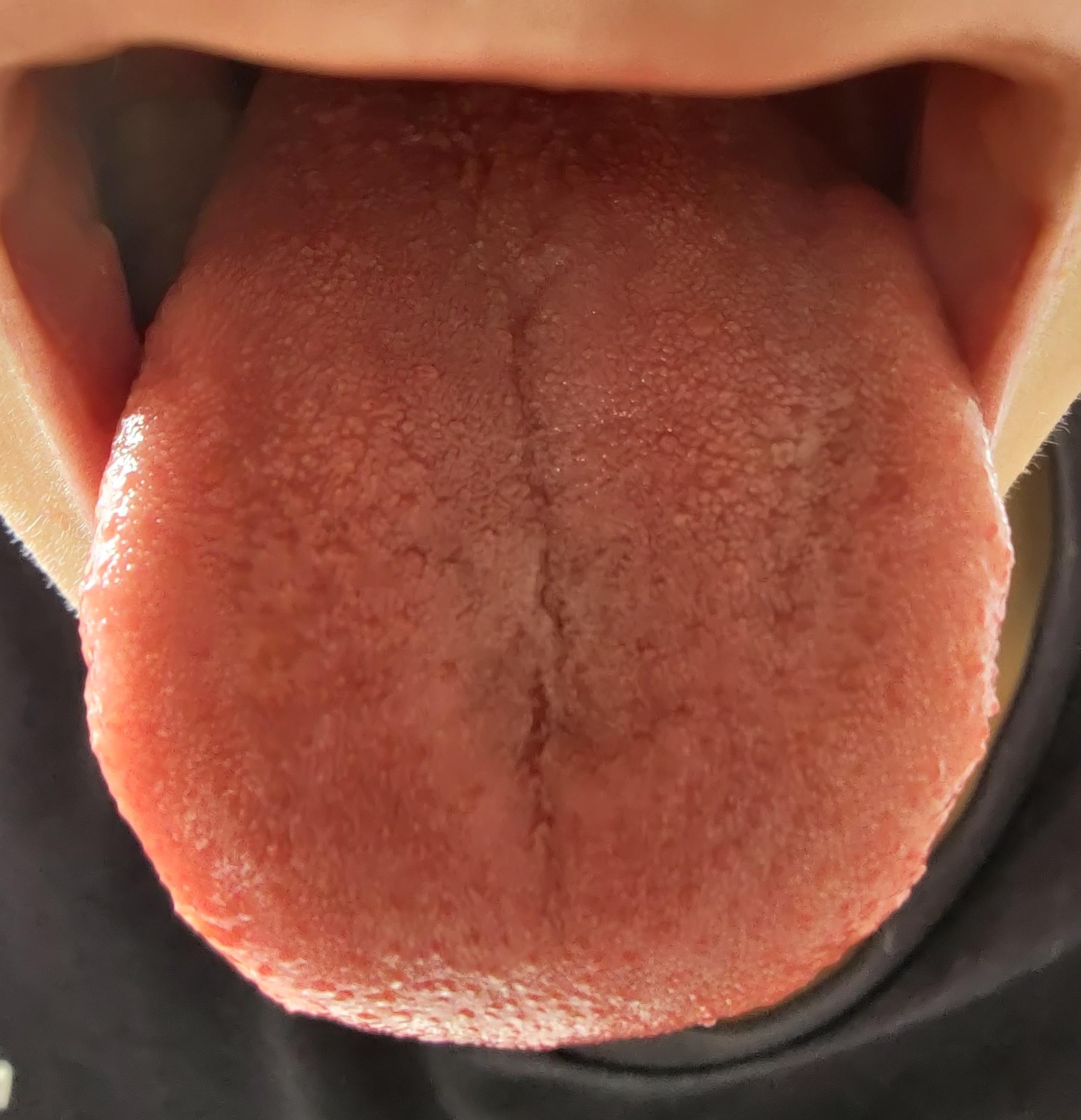 Riss In Der Zunge Normal Nahrstoffmangel Vegan Gesundheit Und Medizin Ernahrung Essen Riss In Der Zunge Normal Nahrstoffmangel Vegan Gesundheit Und Medizin Ernahrung Essen