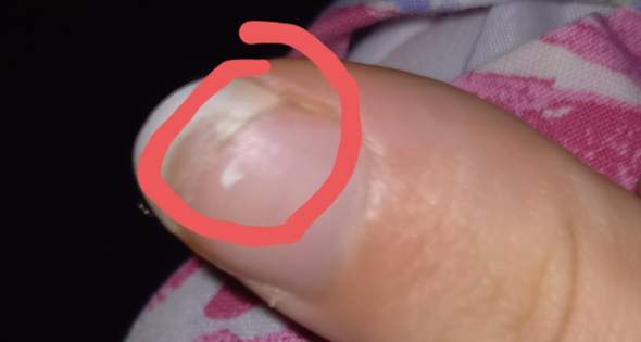 Riss in Finger Nagel was tun?
