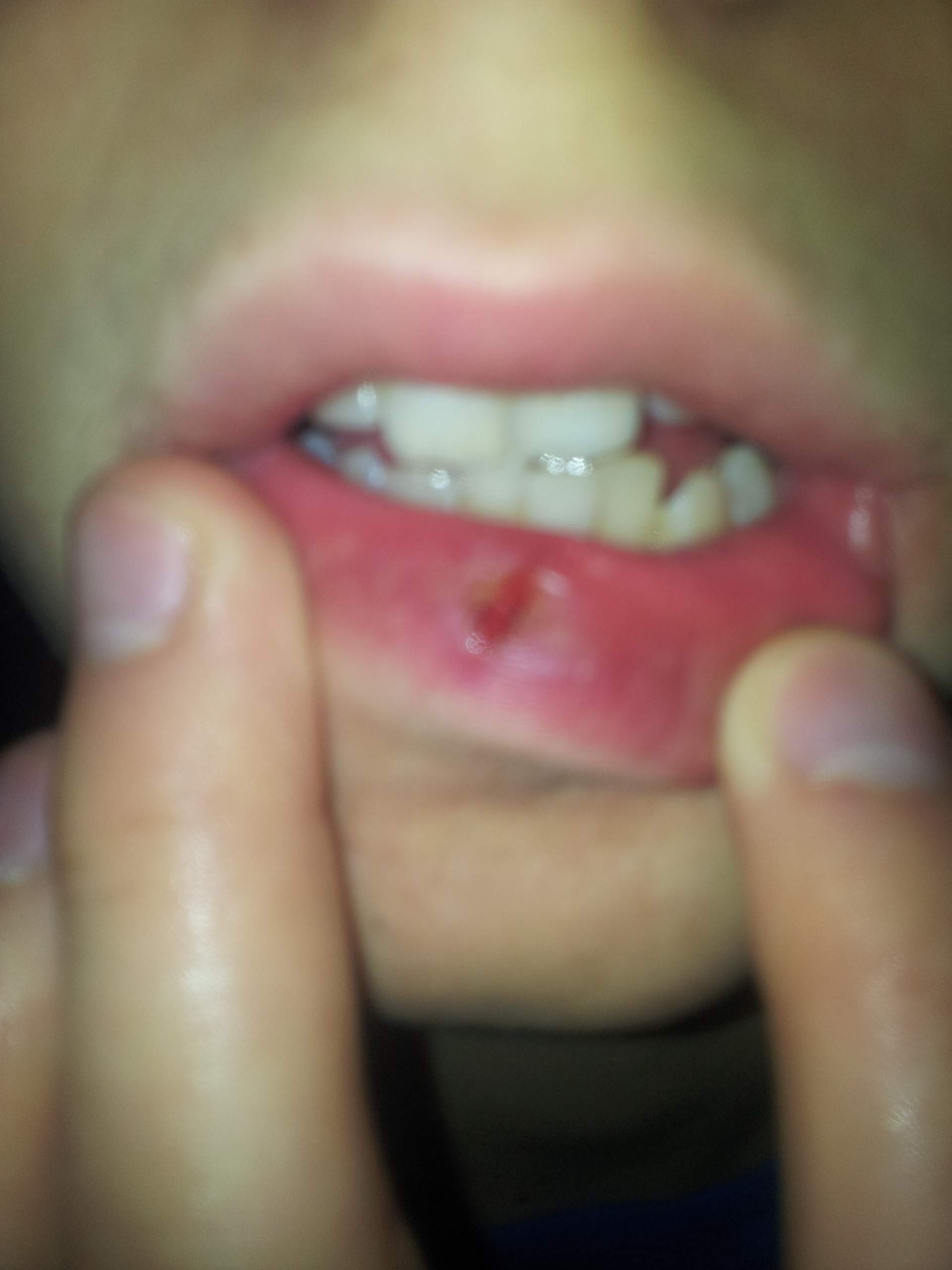 Riss in Lippe was tun? (mit Bild) (Gesundheit, Medizin, Arzt)