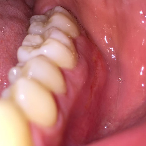 Zahnfleischriss - (Zähne, Zahnarzt, Mund)