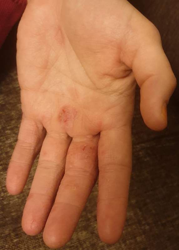 Risse In Den Fingern Und Handen Gesundheit Medizin Haut Risse In Den Fingern Und Handen Gesundheit Medizin Haut