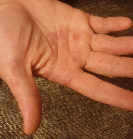 Risse In Den Fingern Und Handen Gesundheit Medizin Haut Risse In Den Fingern Und Handen Gesundheit Medizin Haut