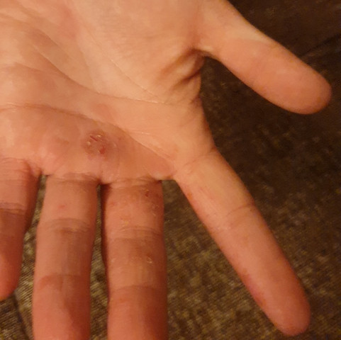 Risse In Den Fingern Und Handen Gesundheit Medizin Haut Risse In Den Fingern Und Handen Gesundheit Medizin Haut