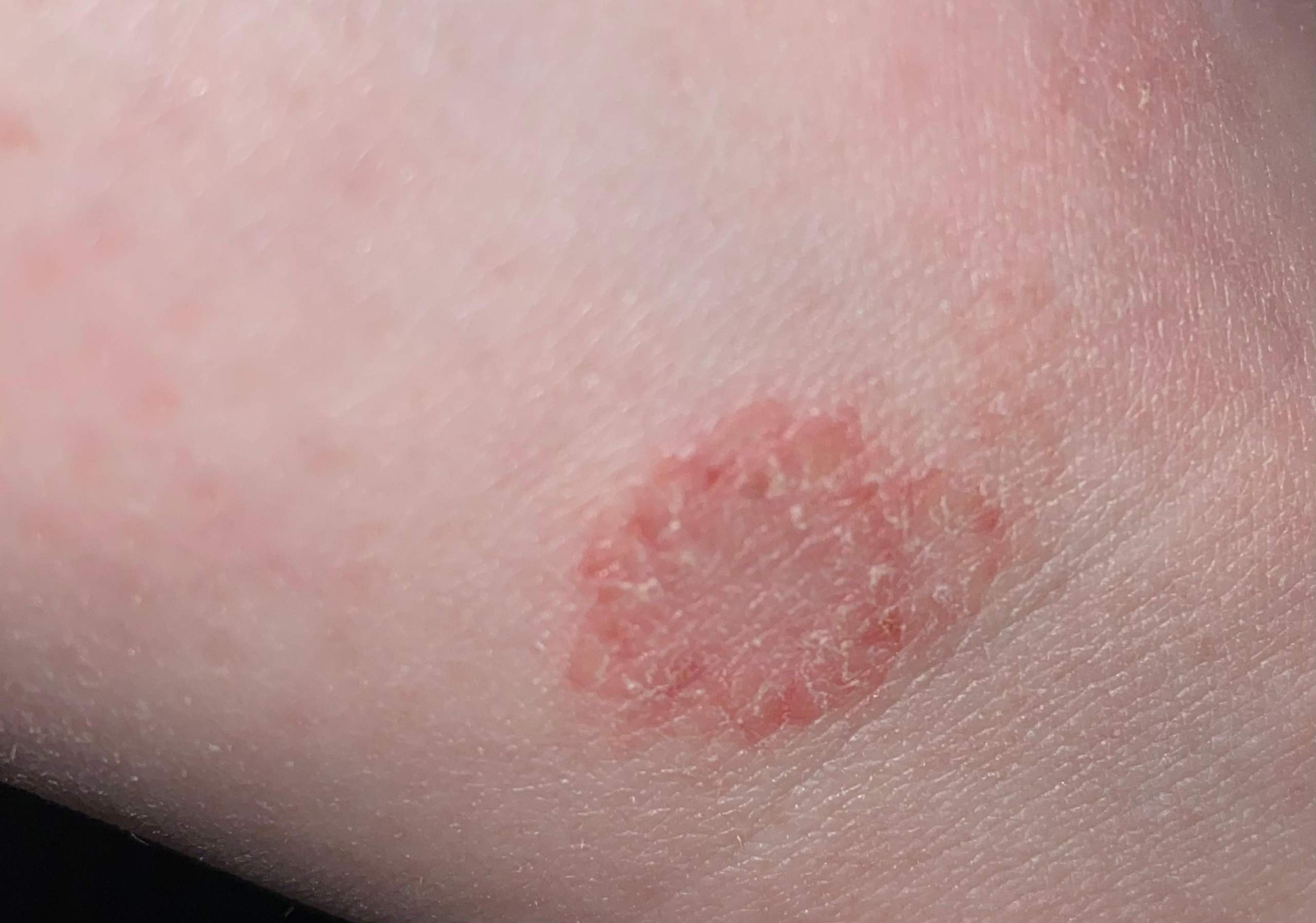 Rissiger „Fleck“ auf der Haut? (Gesundheit und Medizin)
