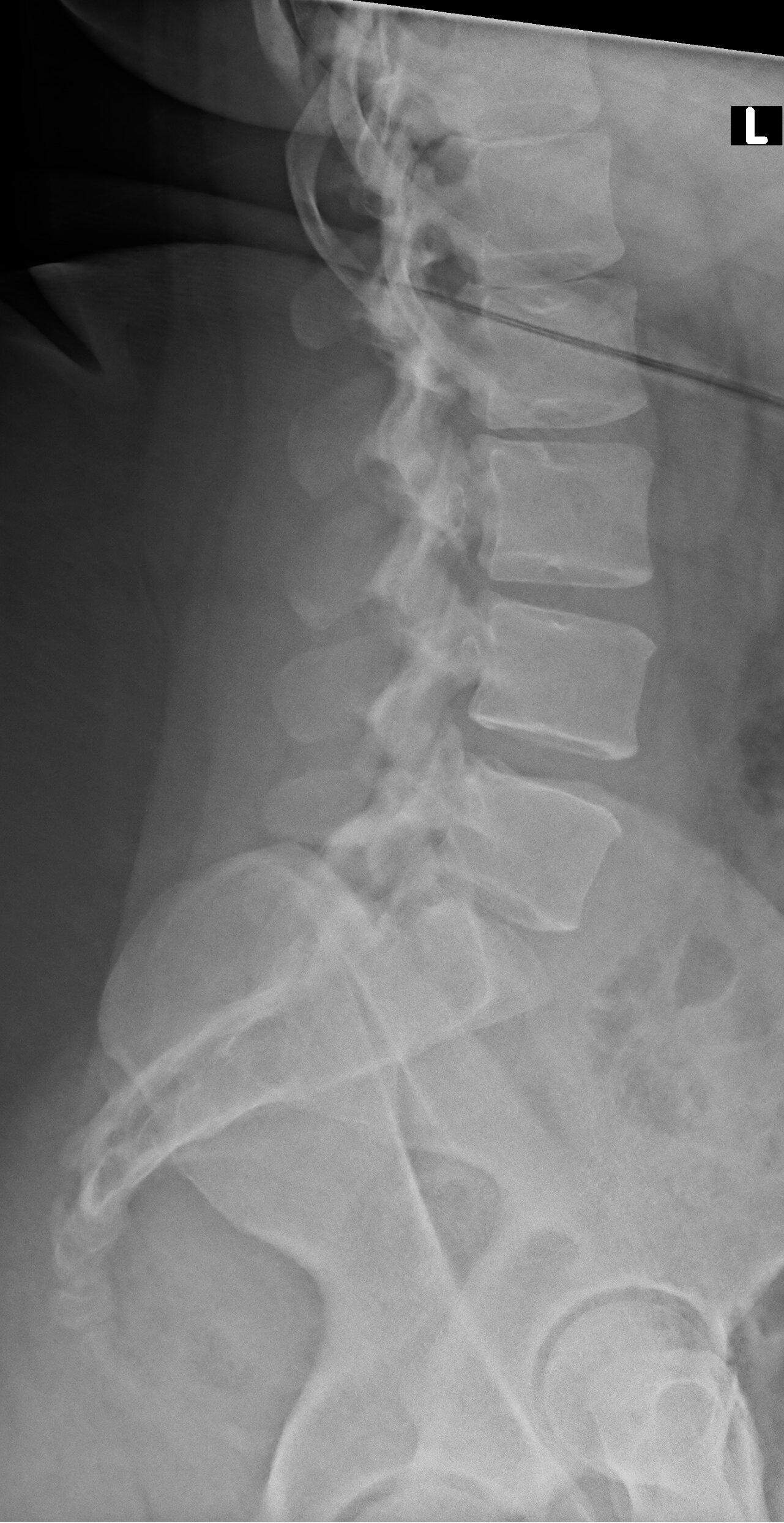 Röntgen LWS Kreuzbein - Befund? (Gesundheit und Medizin)