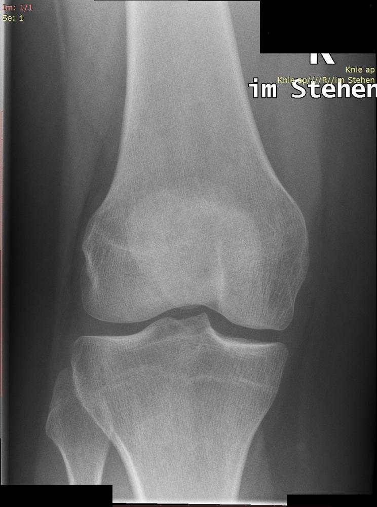 Röntgenbefund Auswertung (Knie, röntgen, kniegelenk)