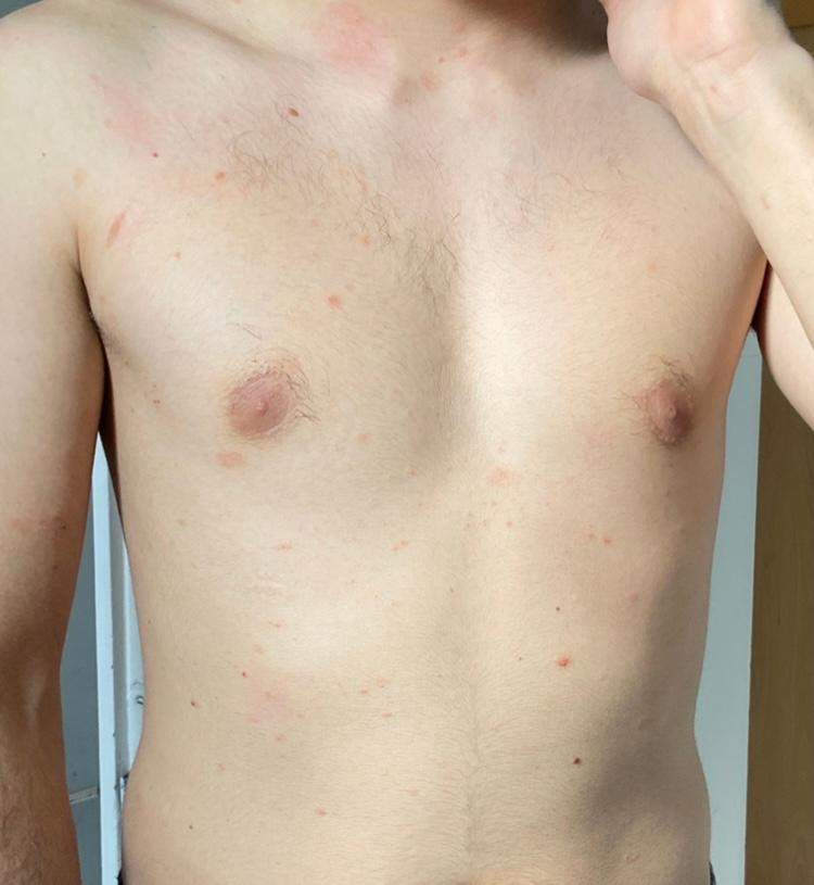 Röschenflechte / Kleienhautpilz oder etwas anderes? (Gesundheit und ...