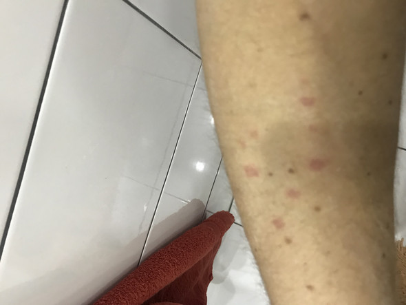 Schuppenflechte An Den Beinen Bilder