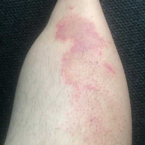 rötliche, wachsende Flecken an den Beinen? (Krankheit, Haut, Beine)