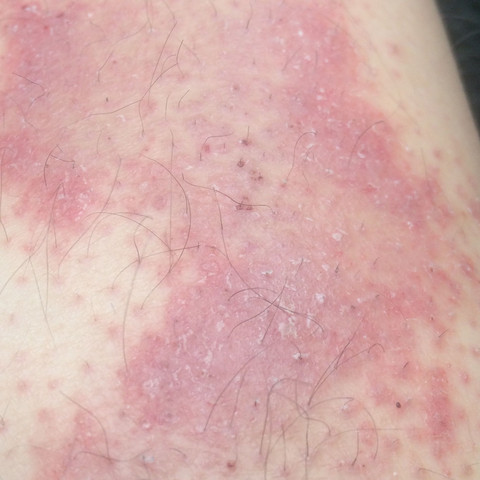 rötliche, wachsende Flecken an den Beinen? (Krankheit, Haut, Beine)