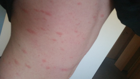 Rotlicher Ausschlag Auf Dem Oberkorper Rotlicher Ausschlag Auf Dem Oberkorper