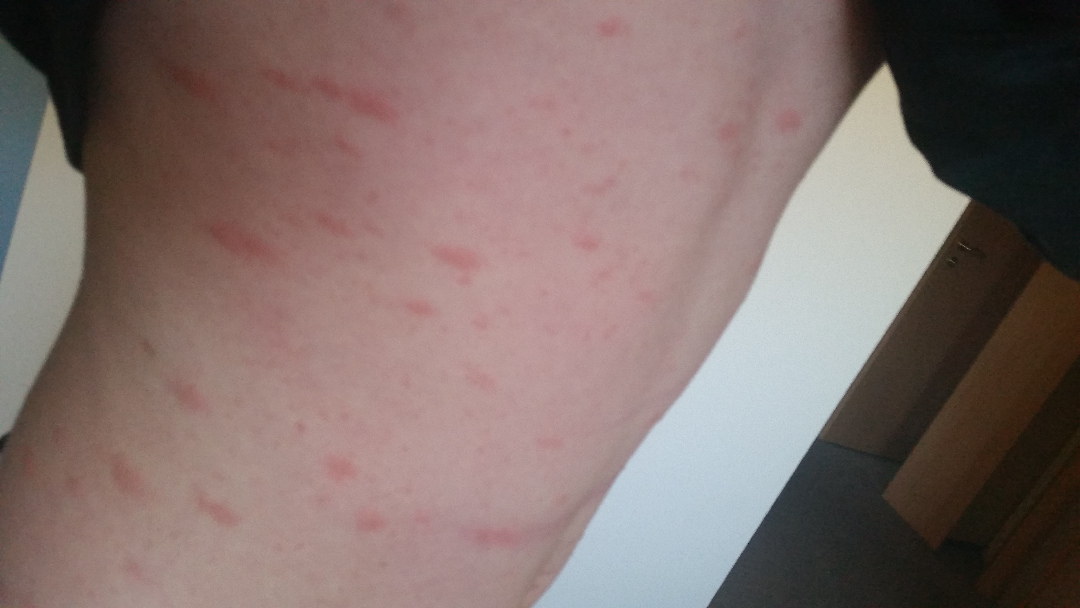 Rötlicher Ausschlag auf dem Oberkörper?