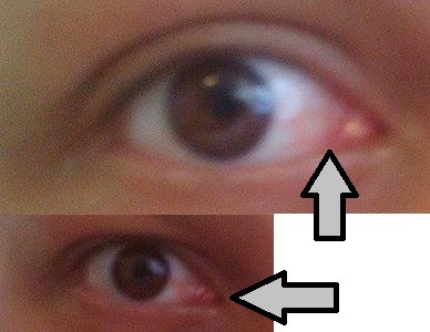 Rötung - (Körper, Augen, Verletzung)