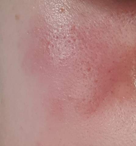 Rotung Im Gesicht Wegbekommen Gesundheit Und Medizin Pickel Hautrotung